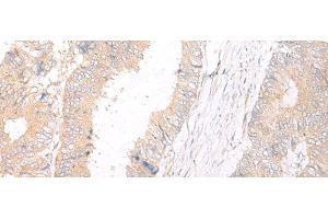 Immunohistochemistry of paraffin-embedded Human colorectal cancer tissue using HLA-C Polyclonal Antibody at dilution of 1:25(x200) (HLA-C antibody)