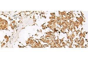 Immunohistochemistry of paraffin-embedded Human lung cancer tissue using PSMD12 Polyclonal Antibody at dilution of 1:40(x200) (PSMD12 antibody)