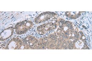 Immunohistochemistry of paraffin-embedded Human gastric cancer tissue using CCNG1 Polyclonal Antibody at dilution of 1:30(x200) (Cyclin G1 antibody)