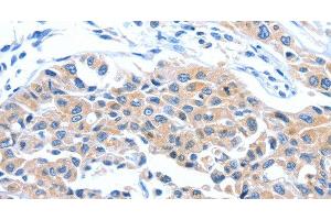 Immunohistochemistry of paraffin-embedded Human lung cancer tissue using ARL11 Polyclonal Antibody at dilution 1:50 (ARL11 antibody)
