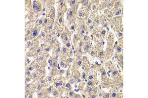 Immunohistochemistry of paraffin-embedded Human liver injury using MPP2 antibody at dilution of 1:100 (x400 lens).