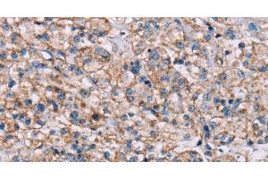 Immunohistochemistry of paraffin-embedded Human prostate cancer tissue using ADAM12 Polyclonal Antibody at dilution 1:40 (ADAM12 antibody)