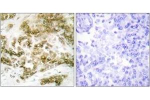 Immunohistochemistry analysis of paraffin-embedded human breast carcinoma tissue, using TBX15/18 Antibody. (T-Box 15/18 antibody  (AA 161-210))