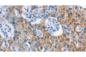 Immunohistochemistry of paraffin-embedded Human lung cancer tissue using ASL Polyclonal Antibody at dilution 1:35 (ASL antibody)