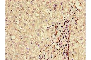Immunohistochemistry of paraffin-embedded human liver cancer using ABIN7145589 at dilution of 1:100 (BAAT antibody  (AA 313-400))
