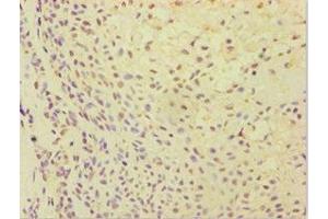 Immunohistochemistry of paraffin-embedded human breast cancer using ABIN7144870 at dilution of 1:100 (ATP5J antibody  (AA 1-108))