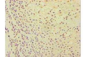Immunohistochemistry of paraffin-embedded human breast cancer using ABIN7144870 at dilution of 1:100 (ATP5J antibody  (AA 1-108))