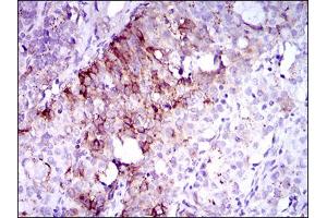 Immunohistochemical analysis of paraffin-embedded cervical cancer tissues using FLT3 mouse mAb with DAB staining. (FLT3 antibody  (AA 930-991))