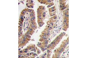 Formalin-fixed and paraffin-embedded human lung carcinoma tissue reacted with Bmp4 antibody (N-term), which was peroxidase-conjugated to the secondary antibody, followed by DAB staining. (BMP4 antibody  (N-Term))