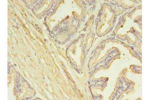 Immunohistochemistry of paraffin-embedded human prostate cancer using ABIN7146360 at dilution of 1:100 (SLC25A25 antibody  (AA 1-189))
