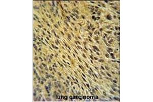 CCDC62 Antibody (C-term) (ABIN651350 and ABIN2840196) immunohistochemistry analysis in formalin fixed and paraffin embedded human lung carcinoma followed by peroxidase conjugation of the secondary antibody and DAB staining.