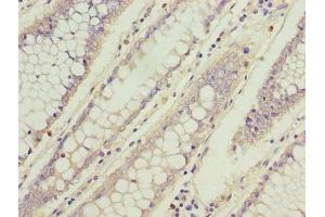 Immunohistochemistry of paraffin-embedded human colon cancer using ABIN7173742 at dilution of 1:100 (TBCC antibody  (AA 2-346))