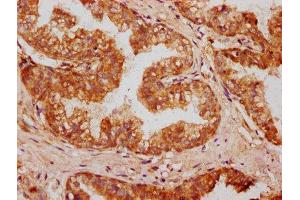 IHC image of ABIN7162317 diluted at 1:400 and staining in paraffin-embedded human prostate cancer performed on a Leica BondTM system. (Osteomodulin antibody  (AA 339-411))