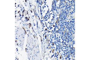Immunohistochemistry of paraffin-embedded human colon carcinoma using STK19 Rabbit pAb (ABIN6132689, ABIN6148598, ABIN6148600 and ABIN6217358) at dilution of 1:100 (40x lens). (STK19 antibody  (AA 75-364))