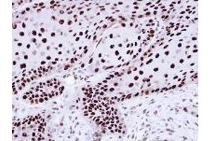 AP19041PU-N hnRNP-C1/C2 antibody staining of Paraffin-Embedded Cal27 xenograft at 1/100 dilution. (HNRNPC antibody  (N-Term))