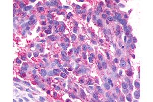 Anti-GPR17 antibody IHC of human Ovary, Carcinoma.