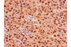 Immunohistochemistry of paraffin-embedded human pancreatic cancer using ABIN7153058 at dilution of 1:100 (Foxk1 antibody  (AA 621-730))