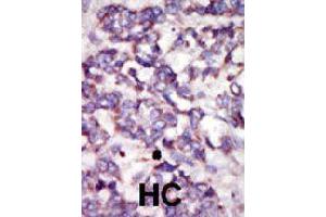 Formalin-fixed and paraffin-embedded human hepatocellular carcinoma tissue reacted with PDK2 polyclonal antibody  , which was peroxidase-conjugated to the secondary antibody, followed by DAB staining . (PDK2 antibody  (AA 378-407))