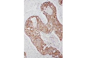 Anti-TNFAIP8L3 antibody, IHC(P) IHC(P): Human Mammary Cancer Tissue (TNFAIP8L3 antibody  (C-Term))
