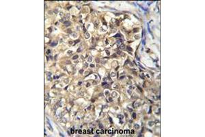 KLHL35 Antibody immunohistochemistry analysis in formalin fixed and paraffin embedded human breast carcinoma followed by peroxidase conjugation of the secondary antibody and DAB staining. (KLHL35 antibody  (C-Term))