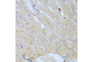 Immunohistochemistry of paraffin-embedded human liver cancer using CEACAM7 antibody at dilution of 1:100 (40x lens). (CEACAM7 antibody)