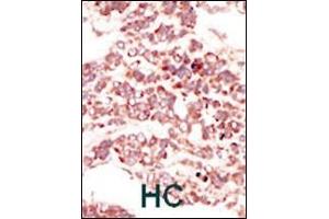 Formalin-fixed and paraffin-embedded human cancer tissue reacted with the primary antibody, which was peroxidase-conjugated to the secondary antibody, followed by DAB staining. (PTK7 antibody  (N-Term))