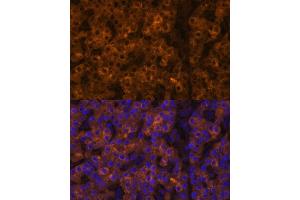 Immunofluorescence analysis of human liver cancer using TTR Polyclonal Antibody (ABIN3021473, ABIN3021474, ABIN3021475 and ABIN6215107) at dilution of 1:100 (40x lens). (TTR antibody  (AA 21-147))