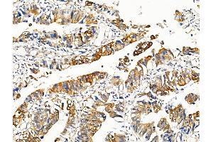 ABIN6256127 and ABIN6267130 at 1/100 staining Human colorectal cancer by IHC-P. (KRT20 antibody  (pSer13))