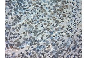Immunohistochemical staining of paraffin-embedded Adenocarcinoma of colon tissue using anti-CTAG1Bmouse monoclonal antibody. (CTAG1B antibody)
