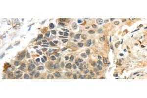 Immunohistochemistry of paraffin-embedded Human esophagus cancer using PROX1 Polyclonal Antibody at dilution of 1/40