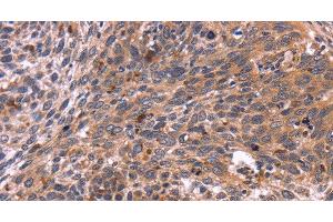 Immunohistochemistry of paraffin-embedded Human cervical cancer tissue using CRK Polyclonal Antibody at dilution 1:40 (Crk antibody)