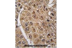 Formalin-fixed and paraffin-embedded human hepatocarcinoma tissue reacted with SUMO2/3 antibody (C-term E69) (ABIN1882138 and ABIN2845503) , which was peroxidase-conjugated to the secondary antibody, followed by DAB staining. (SUMO2/3 antibody  (C-Term))