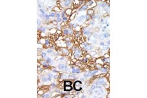 Formalin-fixed and paraffin-embedded human cancer tissue reacted with the primary antibody, which was peroxidase-conjugated to the secondary antibody, followed by DAB staining. (MAP4K1 antibody  (C-Term))