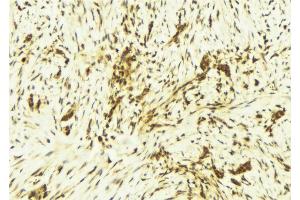 ABIN6269245 at 1/100 staining Human breast cancer tissue by IHC-P. (STAT1 antibody)