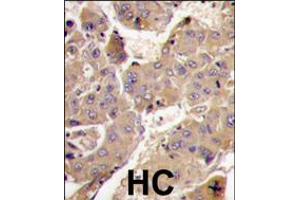 Formalin-fixed and paraffin-embedded human hepatocarcinoma tissue reacted with PIK3R3 antibody , which was peroxidase-conjugated to the secondary antibody, followed by DAB staining. (PIK3R3 antibody  (C-Term))