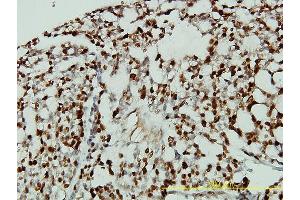 Immunoperoxidase of monoclonal antibody to CDKN1B on formalin-fixed paraffin-embedded human ovary, clear cell carcinoma tissue.