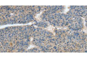 Immunohistochemistry of paraffin-embedded Human liver cancer tissue using ATP4B Polyclonal Antibody at dilution 1:40 (ATP4b antibody)