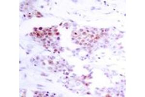 Immunohistochemical analysis of paraffin-embedded human breast carcinoma tissue using MEF2A polyclonal antibody . (MEF2A antibody)