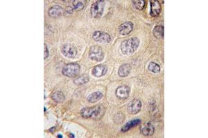 Formalin-fixed and paraffin-embedded human hepatocarcinoma tissue reacted with EDA antibody (N-term) (ABIN390232 and ABIN2840705) , which was peroxidase-conjugated to the secondary antibody, followed by DAB staining. (Ectodysplasin A antibody  (N-Term))