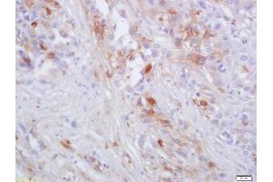 Formalin-fixed and paraffin embedded human lung carcinoma labeled with Anti-CCR-2 Polyclonal Antibody, Unconjugated (ABIN670146) at 1:200 followed by conjugation to the secondary antibody and DAB staining (CCR2 antibody)