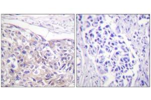 Immunohistochemistry analysis of paraffin-embedded human breast carcinoma tissue using p90 RSK (Phospho-Thr573) antibody.