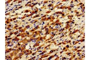 Immunohistochemistry of paraffin-embedded human liver cancer using ABIN7143372 at dilution of 1:100 (GPR124 antibody  (AA 1069-1338))