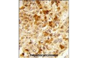 Formalin-fixed and paraffin-embedded human hepatocarcinoma reacted with PX Antibody (Center), which was peroxidase-conjugated to the secondary antibody, followed by DAB staining. (PEX2 antibody  (AA 165-194))