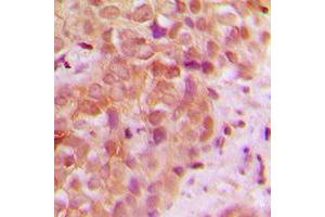 Immunohistochemical analysis of UBR5 staining in human breast cancer formalin fixed paraffin embedded tissue section. (UBR5 antibody  (N-Term))