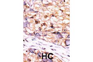 Formalin-fixed and paraffin-embedded human hepatocellular carcinoma tissue reacted with CTDSP1 polyclonal antibody  , which was peroxidase-conjugated to the secondary antibody, followed by DAB staining.