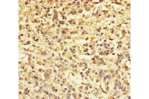 Immunohistochemistry of paraffin-embedded human melanoma using ABIN7172299 at dilution of 1:100 (TMEFF2 antibody  (AA 41-320))