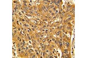 IHC analysis of FFPE human lung carcinoma with Fascin antibody