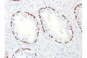 Formalin-fixed, paraffin-embedded human Prostate Carcinoma stained with p63 Mouse Monoclonal Antibody (TP63/2427). (p63 antibody)