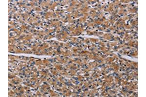 The image on the left is immunohistochemistry of paraffin-embedded Human prostate cancer tissue using ABIN7191790(PARP4 Antibody) at dilution 1/20, on the right is treated with synthetic peptide. (PARP4 antibody)