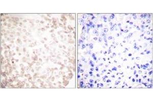 Immunohistochemistry analysis of paraffin-embedded human lung carcinoma tissue, using XRCC1 Antibody.